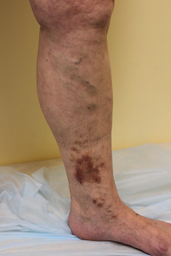 Гиперпигментация Гиперпигментация лечение