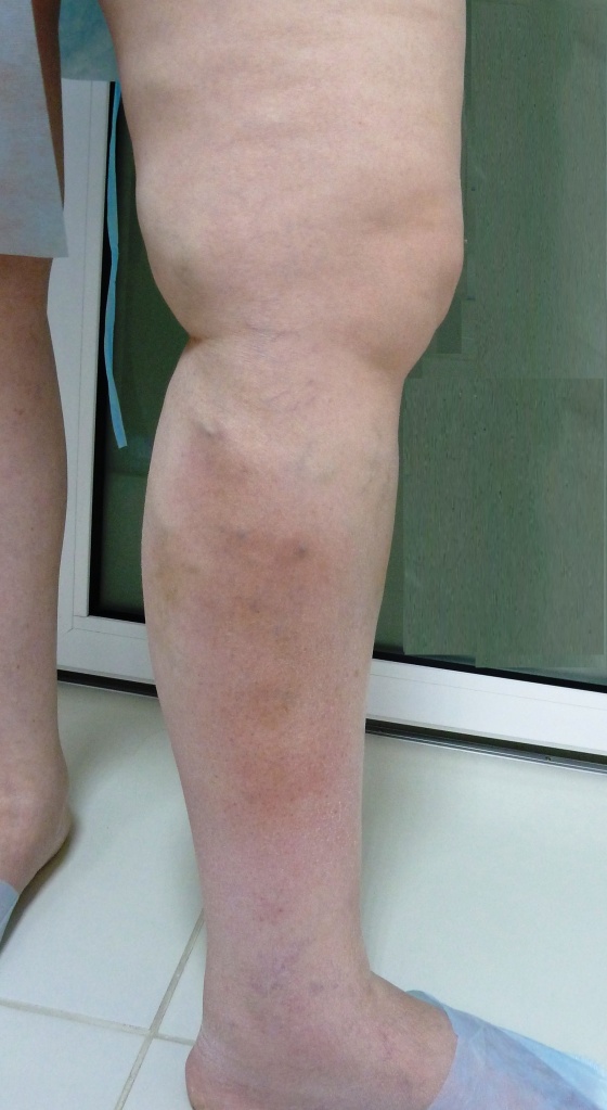 Тромбофлебит Тромбофлебит лечение