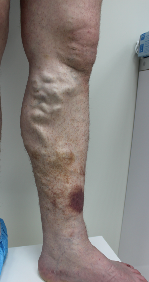 Венозная экзема Венозная экзема лечение