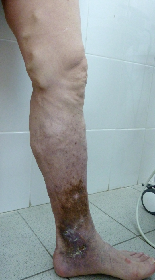 Зажившая трофическая язва Зажившая трофическая язва лечение