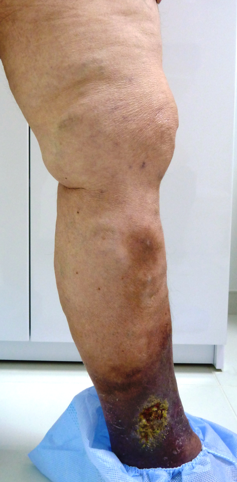 Открытая язва Открытая язва лечение