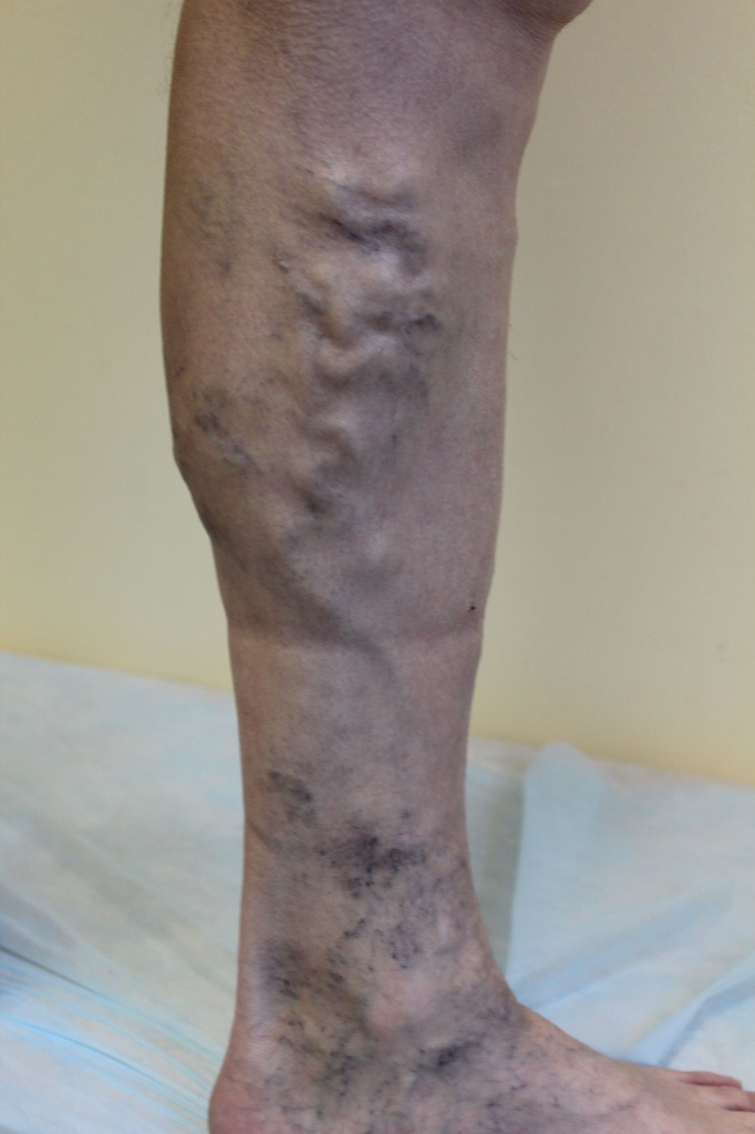 Хронический отек Хронический отек лечение